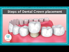 Dental crown demonstration