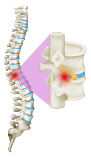 Scoliosis Surgery