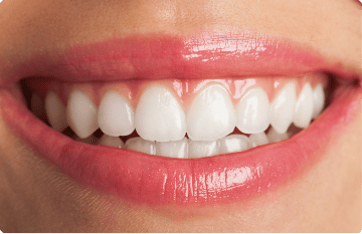 Dental Veneers