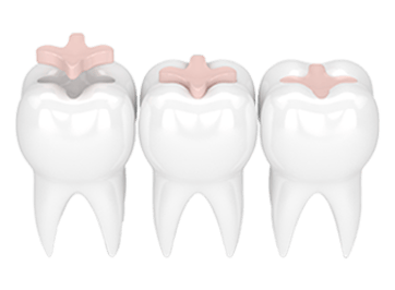 Dental Fillings