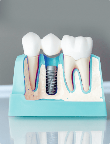 Dental Implants