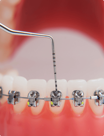 تقويم الأسنان في تركيا