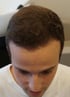 Hair Transplant