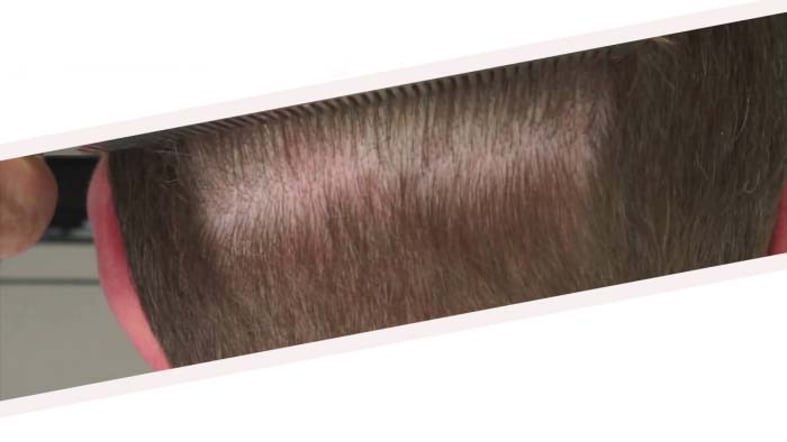 Donor area recovery after hair transplant | علاجك الطبية Donor area recovery after hair transplant | علاجك الطبية