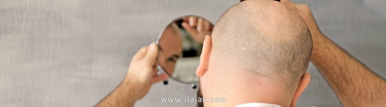 what is pattern baldness ? | علاجك الطبية what is pattern baldness ? | علاجك الطبية