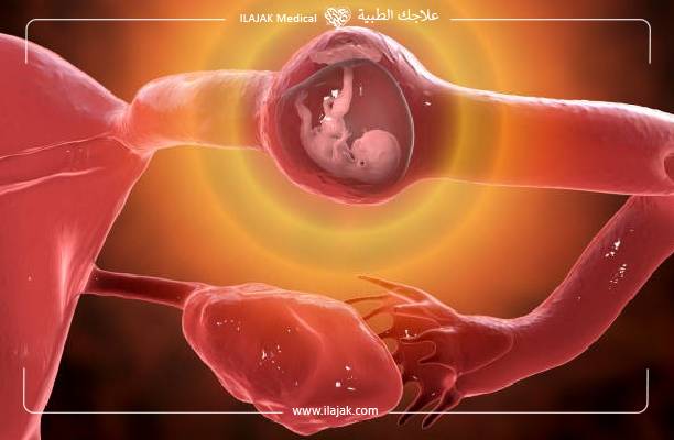 أنواع الحمل خارج الرحم