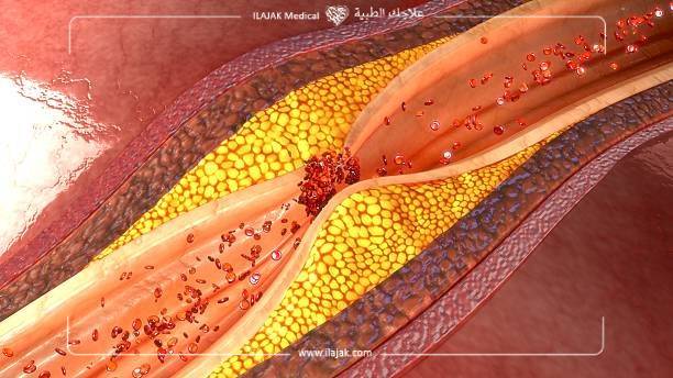 علاج أمراض القلب