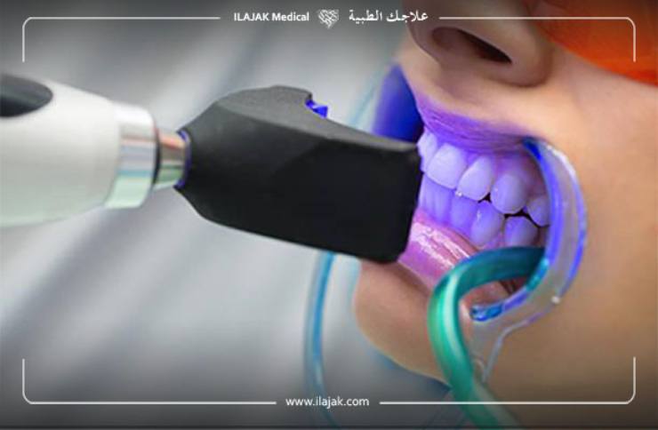 blanchiment des dents avec la technologie Zoom 