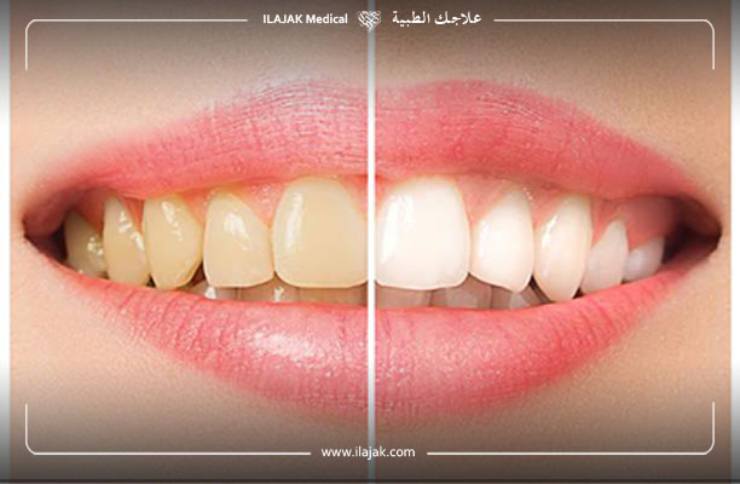 Blanchiment dentaire Zoom avant et après 