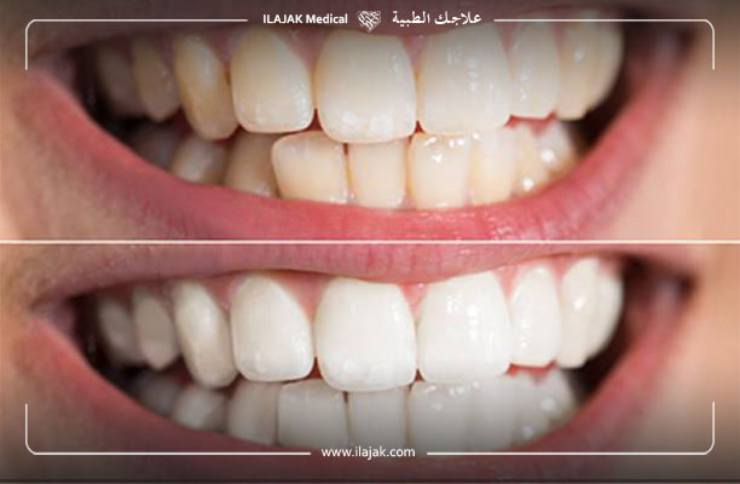 Blanchiment dentaire Zoom avant et après 