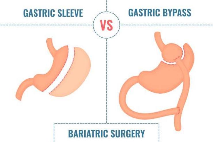 La différence entreLa sleeve gastrique Le bypass gastrique