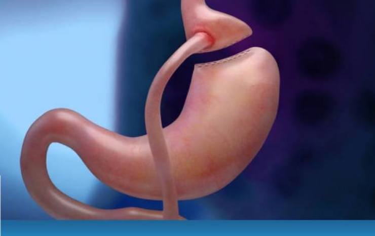 La différence entre La sleeve gastrique Le bypass gastrique