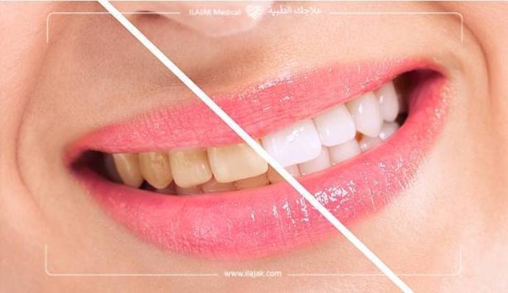 teeth whitening