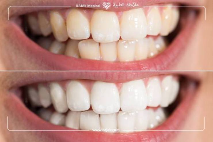 In-office teeth whitening before and after