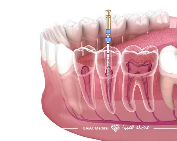 جذور الأسنان, علاج جذور الأسنان, معالجة قناة الجذر, قناة الجذر, أسعار علاج جذور الأسنان