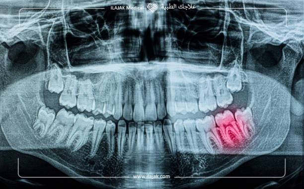 جذور الأسنان, علاج جذور الأسنان, معالجة قناة الجذر, قناة الجذر, أسعار علاج جذور الأسنان