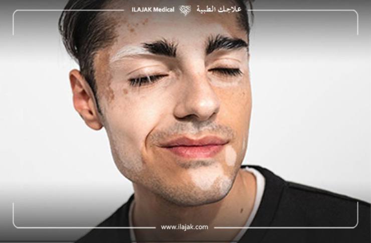 Le vitiligo : causes et traitement | علاجك الطبية