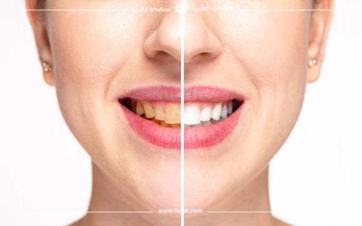Teeth whitening trays before and after