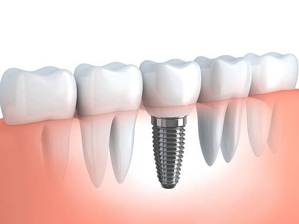 échec d'un implant dentaire