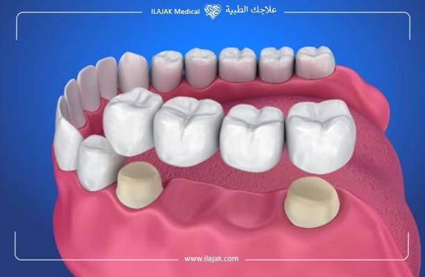 Qu'est-ce qu'un bridge dentaire