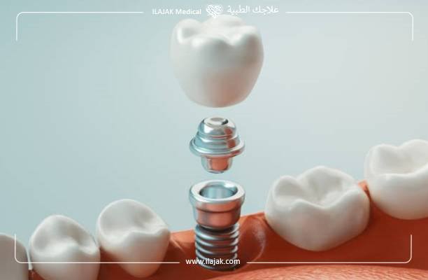 dental implants 