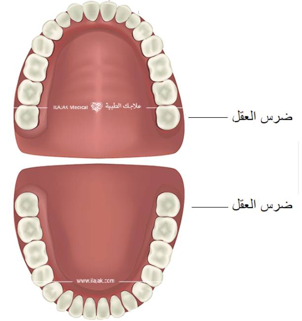 ضرس العقل 