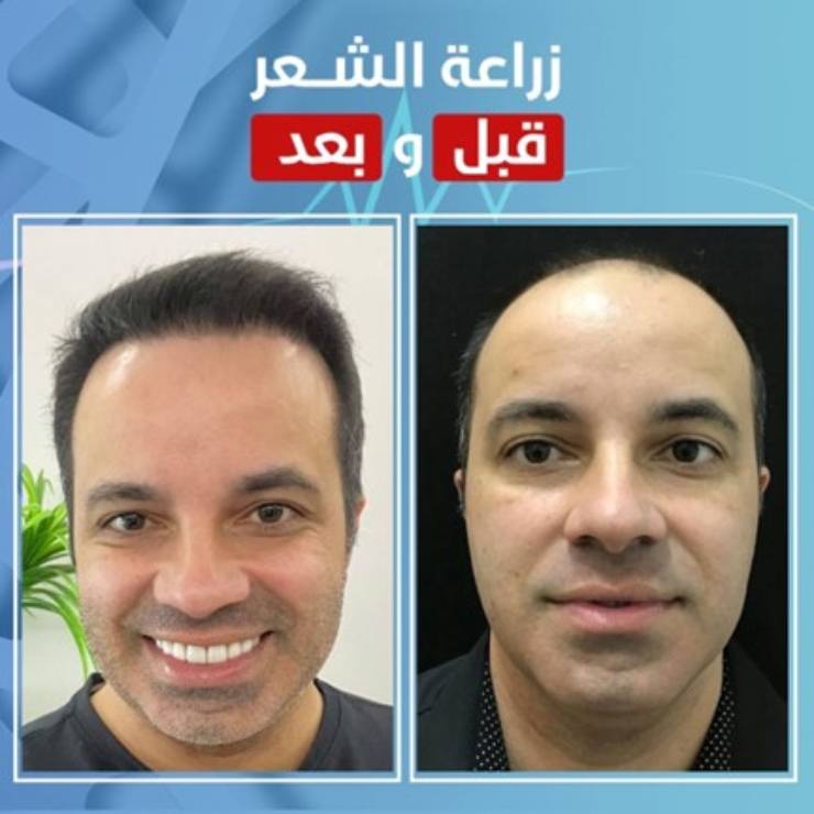 زراعة الشعر قبل وبعد 