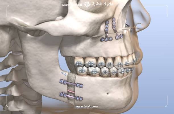 جراحة الفك