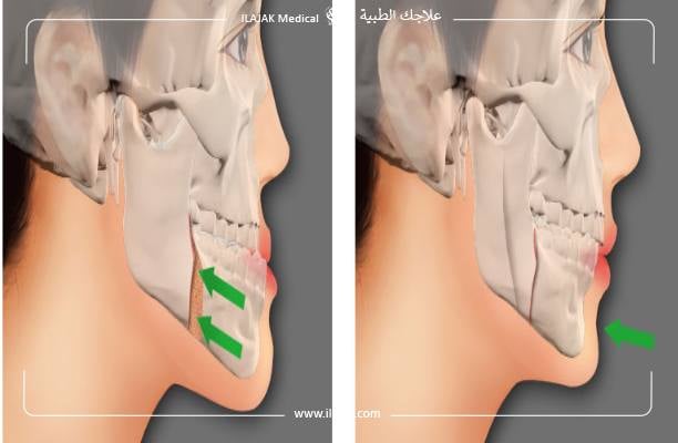 قبل وبعد عملية جراحة الفك
