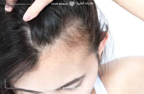  علاج فراغات الشعر من الجوانب