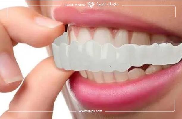 فينير الأسنان المتحرك