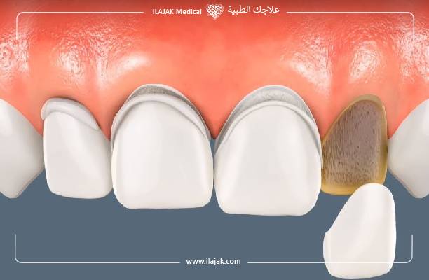 أسعار فينير الأسنان