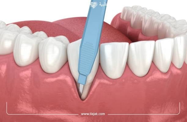 علاج ضعف اللثة