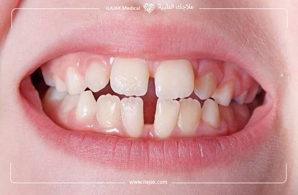 أسباب الأسنان المتفرقة