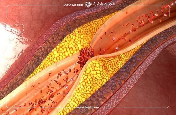 العلاقة بين السمنة وأمراض القلب 