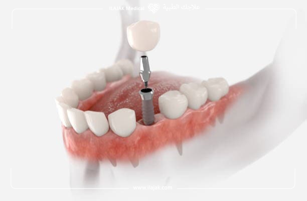 les implants dentaires