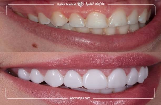 اسعار عمليات تجميل اللثة