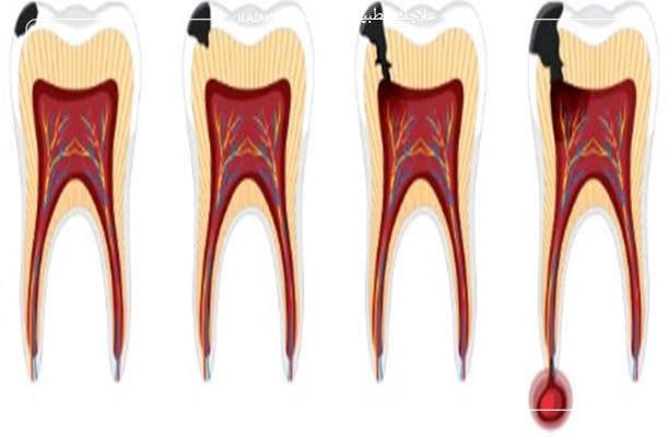 أسباب التهاب عصب الأسنان