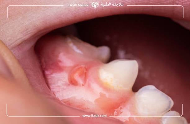 علاج التهاب عصب الاسنان