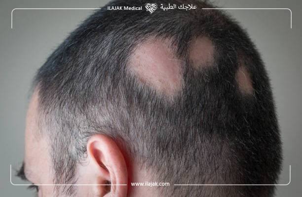 Alopecia areata