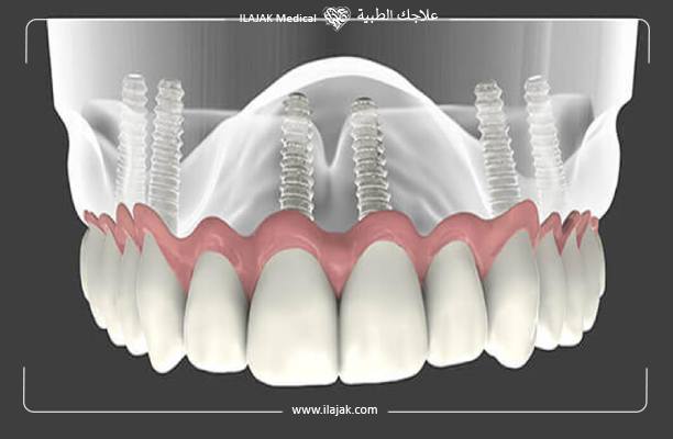 implants dentaires en Turquie