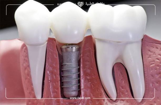 Risques liés à la chirurgie d'implants dentaires