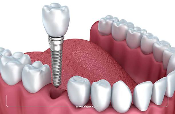 Douleur des implants dentaires