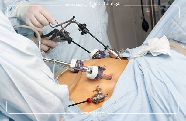 تعليمات بعد عملية تكميم المعدة
