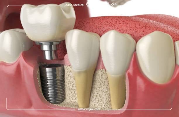 أنواع زرعات الأسنان بدون جراحة
