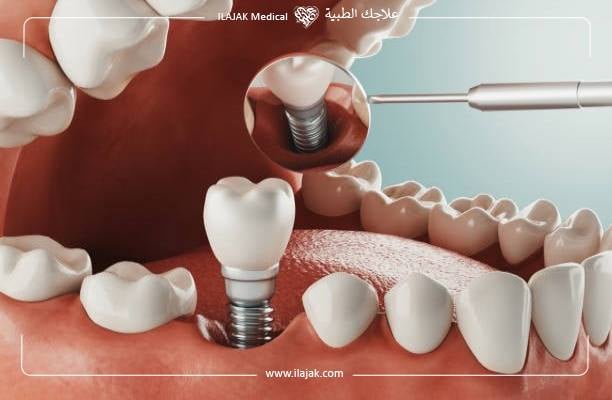 زراعة الأسنان لمرضى السكر