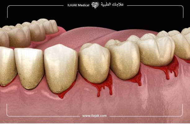  النزيف بعد زراعة الأسنان
