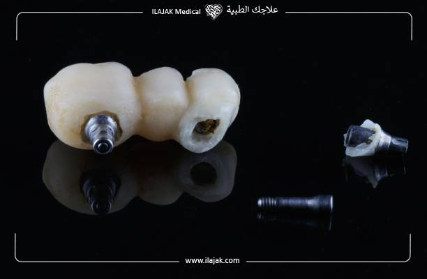 Echec de l’implant dentaire