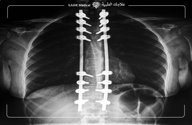 جراحة الجنف العمود الفقري