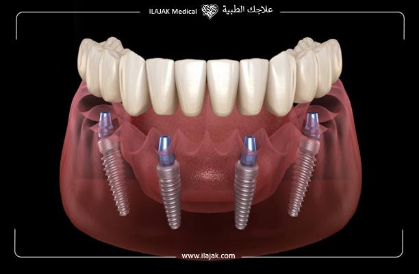 What are the advantages of All-on-4 implant